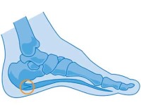 epine-calcaneenne-osteopathie